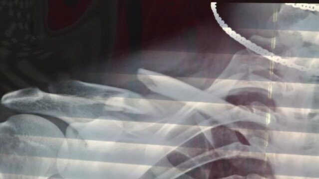 X-ray image showing a broken clavicle bone. An injured shoulder in a man. A close-up video of a post-x-ray image