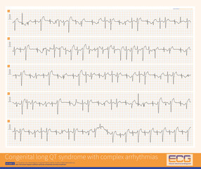 A 4-year-old boy with a clinical diagnosis of long QT syndrome. No genetic testing was done during hospitalization. The child died suddenly during follow-up.