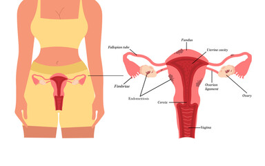 Endometriosis Sick female reproductive system Painful menstruation concept.