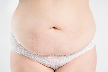 Tummy tuck, flabby skin with stretch marks on a fat belly, plastic surgery concept on light gray background