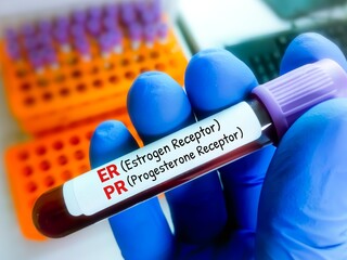 Blood sample for ER and PR PCR testing for breast cancer diagnosis. Estrogen receptor and...