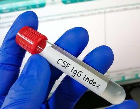 CSF IgG index measures the levels of IgG in cerebrospinal fluid. High levels of IgG may means an infection or an inflammatory or autoimmune disease that involve in central nervous system.