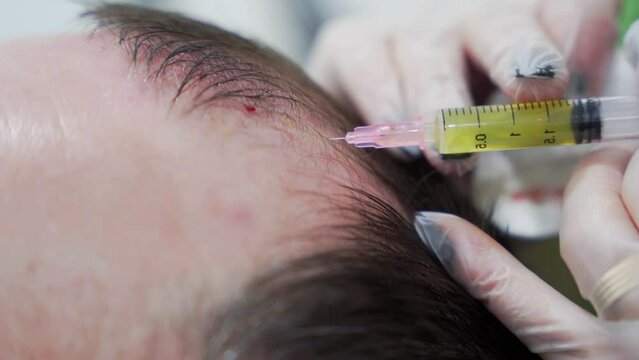 Macro shot of Hair mesotherapy procedure in the modern cosmetology clinic, plasma injectiions. Middle aged male patient prp procedure for hair regrowth