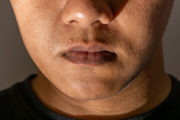 Inflammatory purulent acne. close up of man face with pustule acne. pimple on face skin