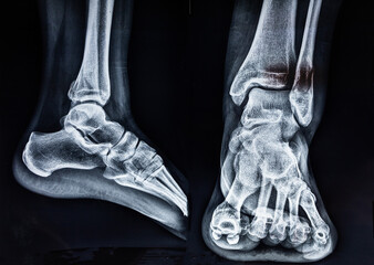 X-ray image of a human female ankle fracture