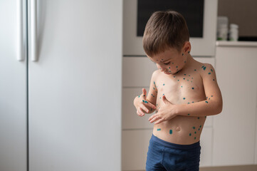 The boy points his finger at the spots on the skin that is cured with brilliant green antiseptic. ...
