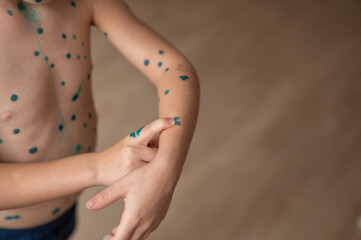 The boy points his finger at the spots on the skin that is cured with brilliant green antiseptic. ...