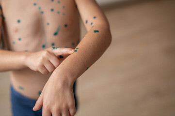 Naklejka premium The boy points his finger at the spots on the skin that is cured with brilliant green antiseptic. Chickenpox or varicella zoster virus. Treatment with brilliant green