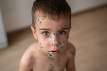 A close-up portrait of a boy whose face is covered with pimples of chickenpox anointed with green...