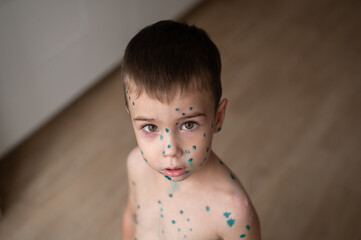 A close-up portrait of a boy whose face is covered with pimples of chickenpox anointed with green...