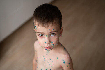 The boy points his finger at the spots on the skin that is cured with brilliant green antiseptic. ...