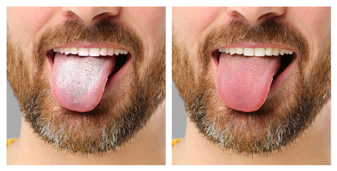 Collage with photos of man before and after tongue cleaning, closeup © New Africa