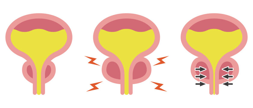 正常な前立腺と前立腺肥大のイラスト