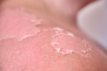Fototapeta premium Effects of sunburn on human skin, close-up.