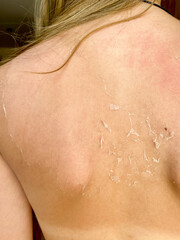 Excessive tan. The effects of sunburn on the skin. Exfoliation of the skin after sunburn