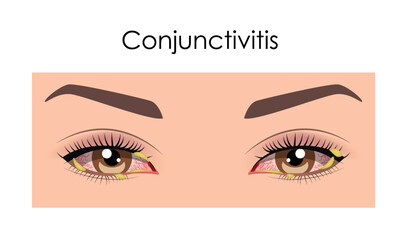 Conjunctivitis, eye disease. Medicine flat vector illustration