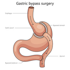 Gastric bypass surgery stomach is divided diagram schematic raster illustration. Medical science educational illustration