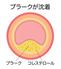 動脈硬化によりプラークで狭窄した血管の縦断面図のイラスト