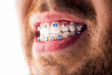 Man braces. Teeth braces on the white teeth of man to equalize the teeth. Bracket system in smiling...
