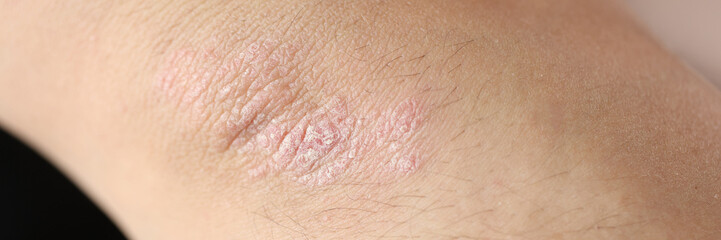 Damaged, dry itchy skin on elbow area close-up.