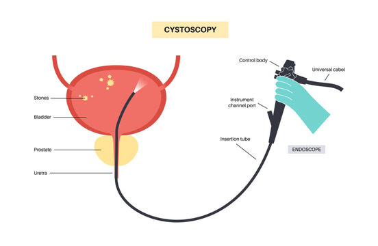 Cystoscopy examination concept