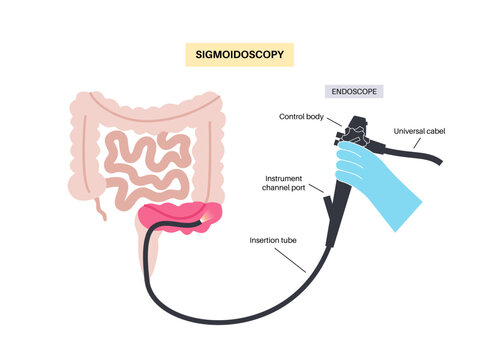 Sigmoidoscopy medical procedure
