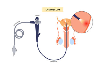 Cystoscopy examination concept