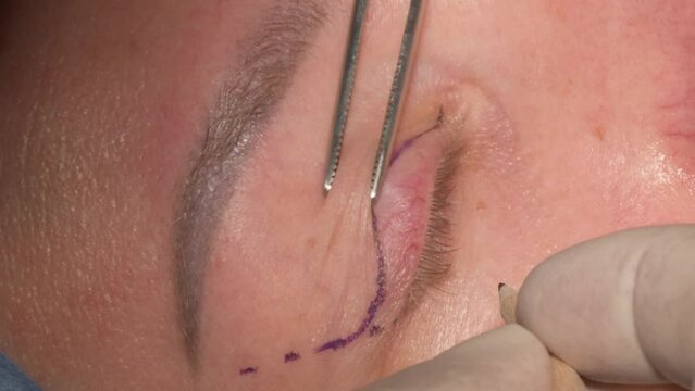 Eyelid Surgery Blepharoplasty Marking 7