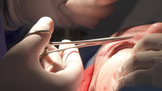 Eyelid Surgery Stitching 3