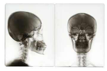 X ray image of human skull