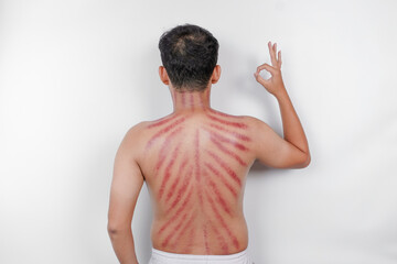 Red marks from scrapes coin on a man's back. Kerokan is a way of traditional Javanese culture...