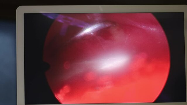 surgical plastic surgery with an endoscope, endoscopic surgery