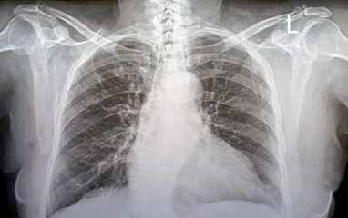 Plain x ray chest of an old woman with almost normal study of bones, lungs and heart, normal chest...