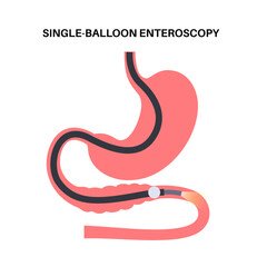 Single balloon enteroscopy