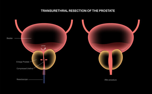 Transurethral resection of the prostate