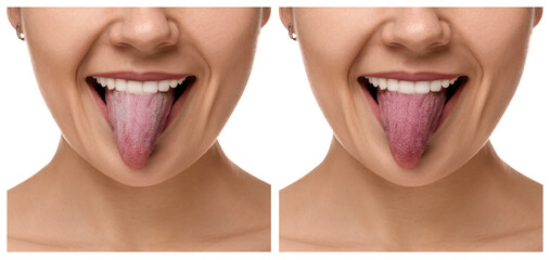 Collage with photos of woman before and after tongue cleaning on white background, closeup