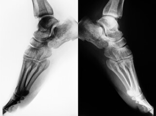  X-ray film of foot.