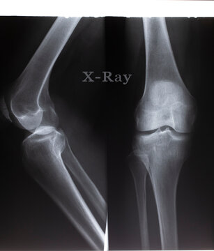 X ray image of knee.