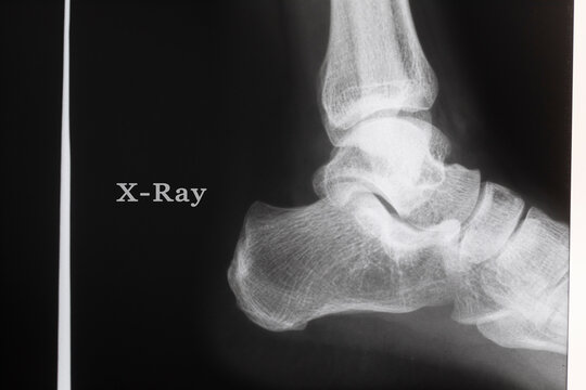  X-ray film of foot.
