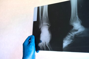 X-ray, a picture of the leg bones after surgery in the hands of a doctor