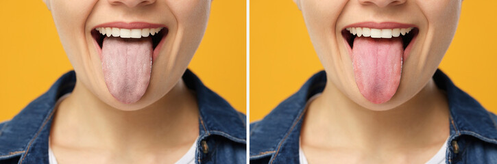 Collage with photos of woman before and after tongue cleaning on yellow background, closeup