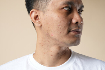 Side profile of a young Asian man with problem skin, isolated on beige background.