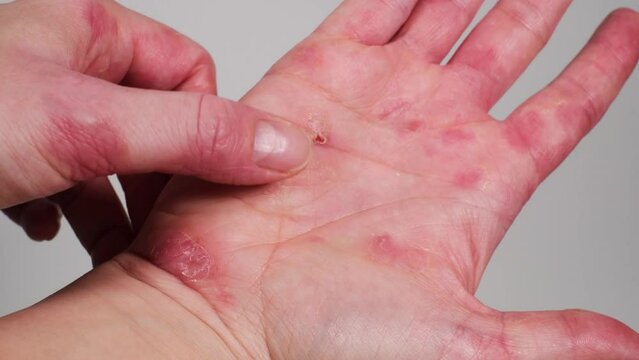 Woman scratching her cracked dry skin of palm. Red stains on female hand after confluent blisters and inflammation of eczema. Allergic reaction, psoriasis, damaged skin, dermatological disease. 4K