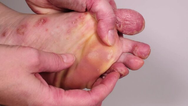 Woman scratches her toes with her finger. Huge wound on female foot after several confluent blisters of eczema. Acute psoriasis, chemical irritation, allergic reaction, dermatological disease on foot.