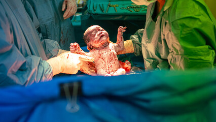 Newborn baby in the cesarean section. The operating team performs the surgery, the doctor performs...
