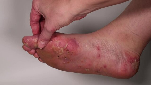 Woman scratches her toes with her finger. Huge wound on female sole after several confluent blisters of eczema. Acute psoriasis, chemical irritation, allergic reaction, dermatological disease on foot.
