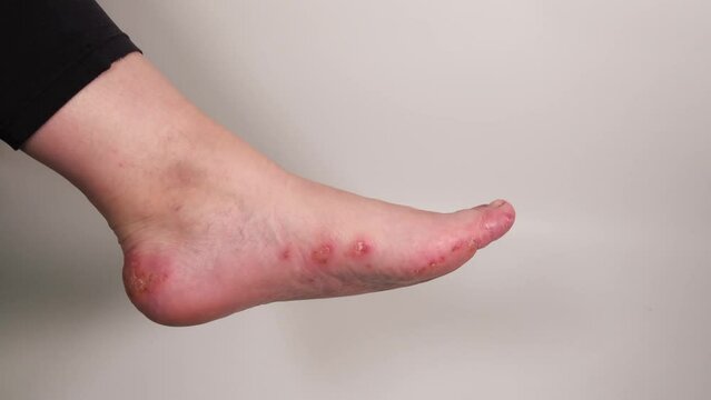 Woman showing her damaged foot. Red inflamed wounds on female skin after several confluent blisters of eczema. Acute psoriasis, chemical irritation, allergic reaction, dermatological disease.