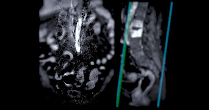 MRI L-S spine or lumbar spine showing spinal tuberculosis.