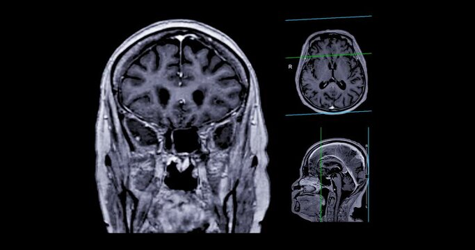 MRI Brain with reference line can help doctors look for conditions such as bleeding, swelling, tumors, infections, inflammation, damage from an injury or a stroke diseases.