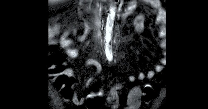 MRI L-S spine or lumbar spine showing spinal tuberculosis.